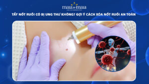 tẩy nốt ruồi có bị ung thư không
