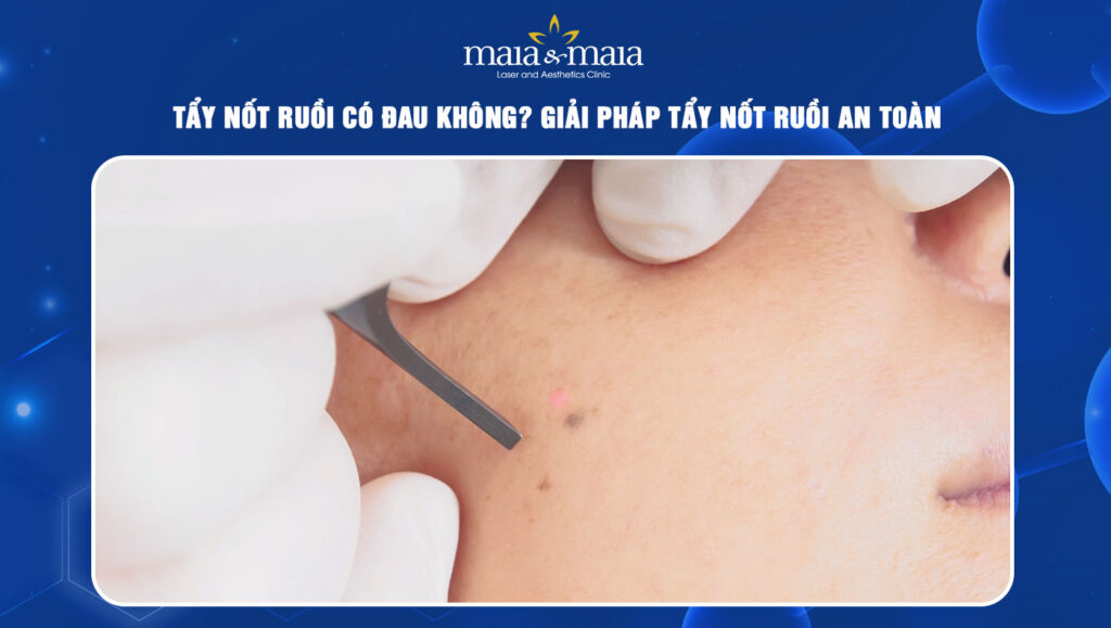 Tẩy nốt ruồi có đau không? Giải pháp tẩy nốt ruồi an toàn 1 tẩy nốt ruồi có đau không