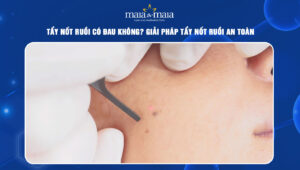 tẩy nốt ruồi có đau không