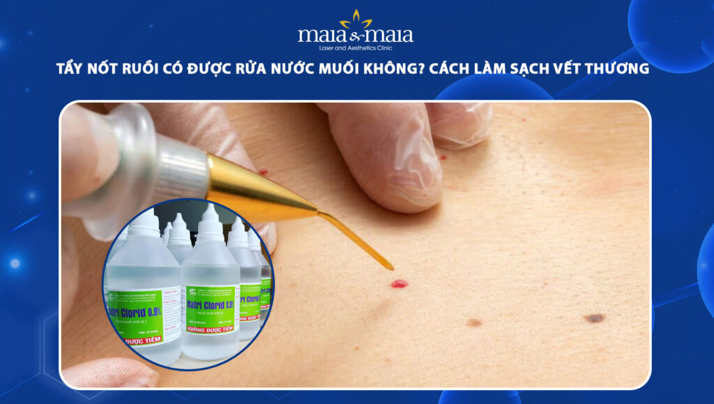 tẩy nốt ruồi có được rửa nước muối không