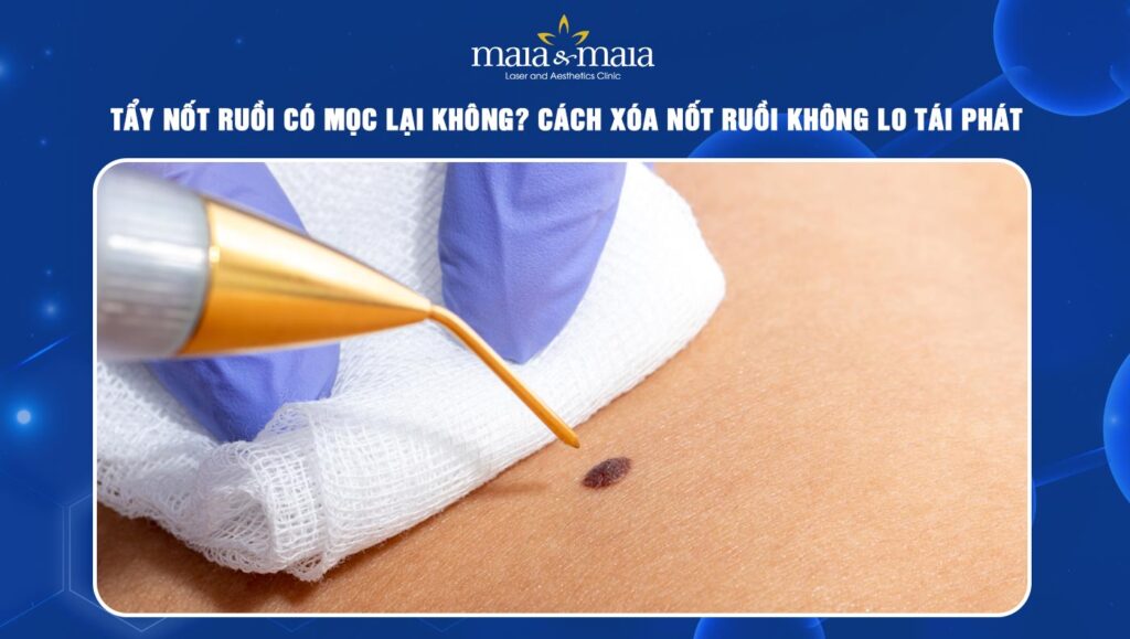 tẩy nốt ruồi có mọc lại không