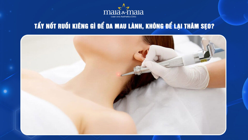tẩy nốt ruồi kiêng gì