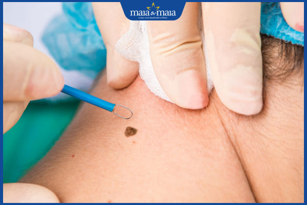 Tìm hiểu ý nghĩa nốt ruồi ở cổ qua từng vị trí cụ thể 6 tẩy nốt ruồi ở cổ