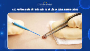 Tẩy nốt ruồi to và lồi