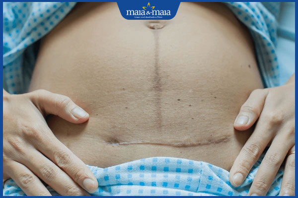 Tổng hợp các loại kem trị thâm bụng sau sinh được ưa chuộng hiện nay 2 thâm bụng sau sinh