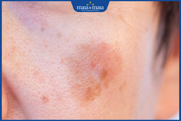 Hướng dẫn cách trị vết thâm sau khi bắn laser hiệu quả 2 thâm da