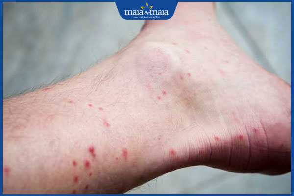 thâm đỏ do bọ chét