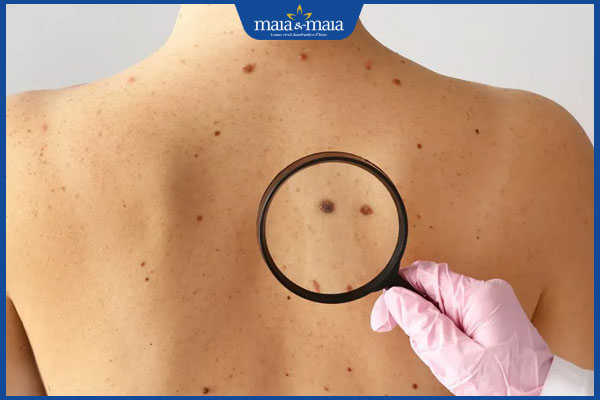 Nốt ruồi không điển hình nguy hiểm không? Dấu hiệu nhận biết 3 thăm khám nốt ruồi