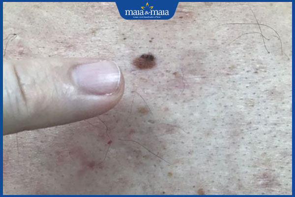 thâm sau tẩy nốt ruồi