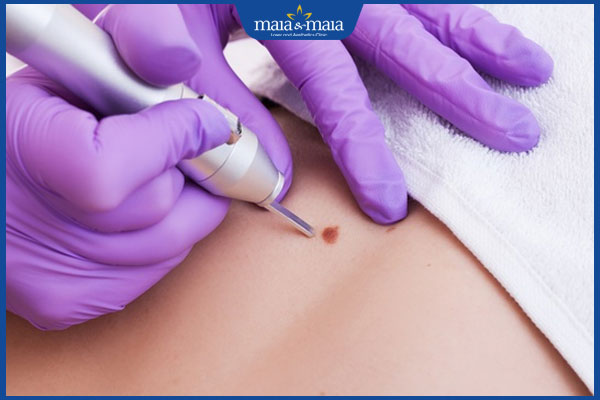 Tẩy nốt ruồi bằng laser CO2: Hiệu quả, quy trình và chi phí 2 thực hiện xóa nốt ruồi