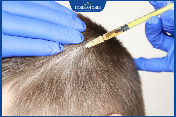 tiêm meso vào tóc