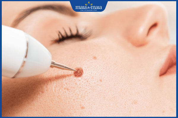 tien hanh tay not ruoi