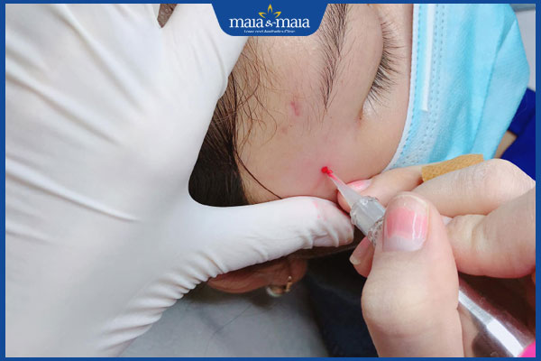 tiến hành xăm nốt ruồi son