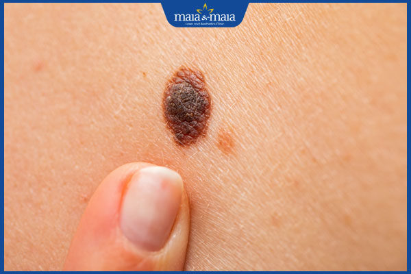 Nốt ruồi đóng vảy do đâu? Nhận biết nốt ruồi bị đóng vảy 2 tình trạng nốt ruồi đóng vảy