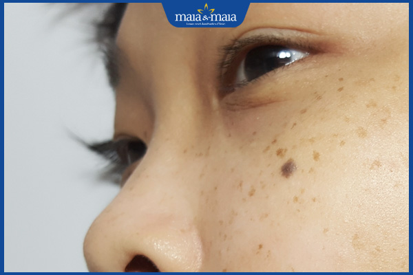 trẻ có nốt ruồi