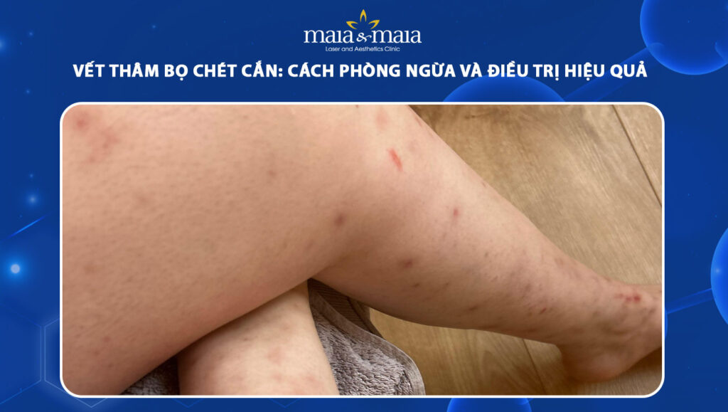 vết thâm bọ chét cắn