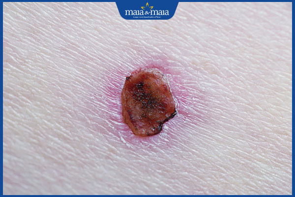 Tẩy nốt ruồi bao lâu thì bong vảy? Cách để vảy bong nhanh 3 vết thương đóng vảy