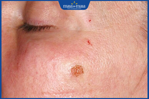 vết thương sau đốt nốt ruồi