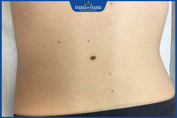 Tìm hiểu vị trí 10 nốt ruồi phá tướng mang đến sự xui xẻo 2 vị trí nốt ruồi phá tướng