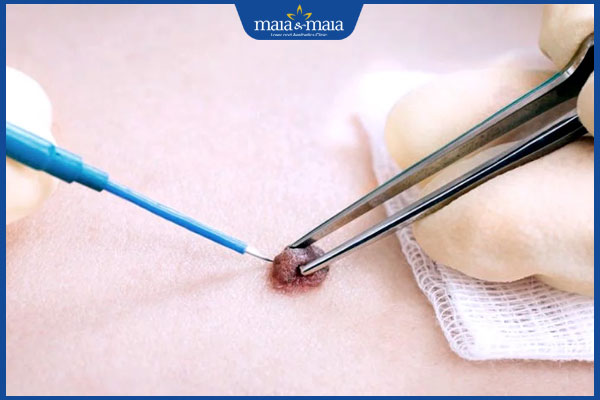 Tẩy nốt ruồi bằng đốt điện hiệu quả ra sao? Cần lưu ý gì? 3 xóa nốt ruồi bằng đốt điện