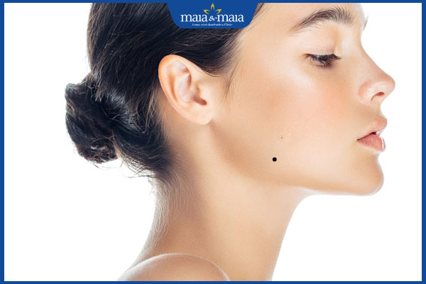 xương quai hàm phải có nốt ruồi