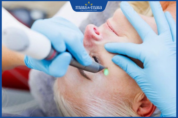 bắn laser quầng thâm