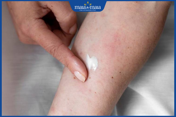 Vết thâm kiến ba khoang phải làm sao? Giải pháp hiệu quả 3 bôi kem làm mờ thâm