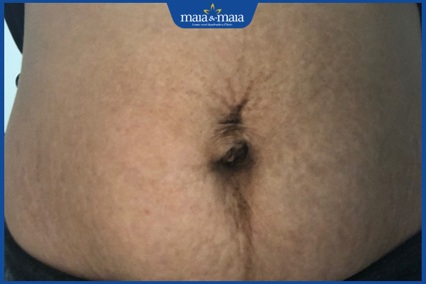 bụng thâm sau sinh