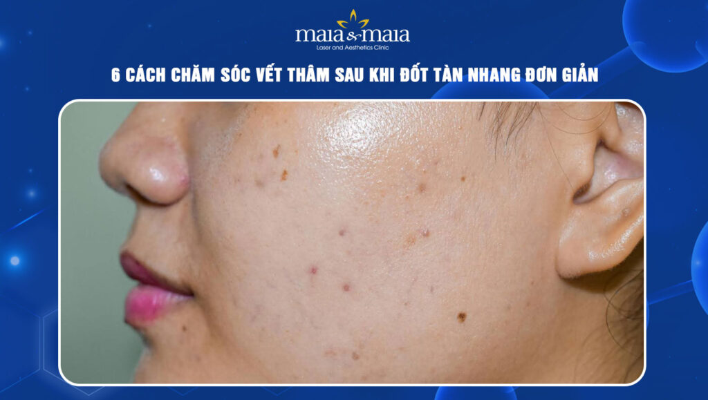 6 cách chăm sóc vết thâm sau khi đốt tàn nhang đơn giản 1 cách chăm sóc vết thâm sau khi đốt tàn nhang