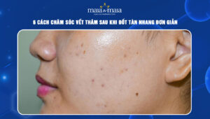 cách chăm sóc vết thâm sau khi đốt tàn nhang