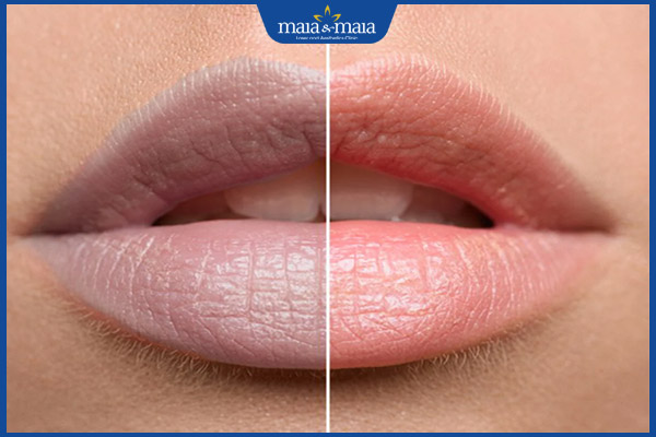 Trị thâm môi bằng kim lăn là phương pháp gì? Hiệu quả không? 4 cải thiện môi thâm