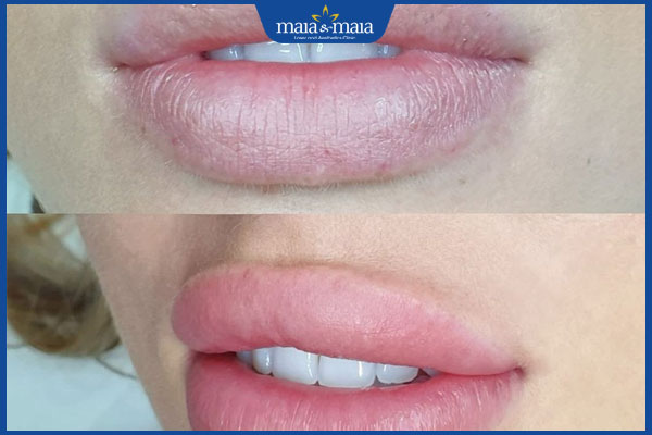 chọn màu khử theo độ thâm của môi