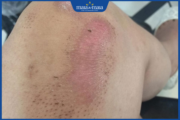 Vết thương lên da non bị thâm có cải thiển được không? 2 da non thâm đỏ