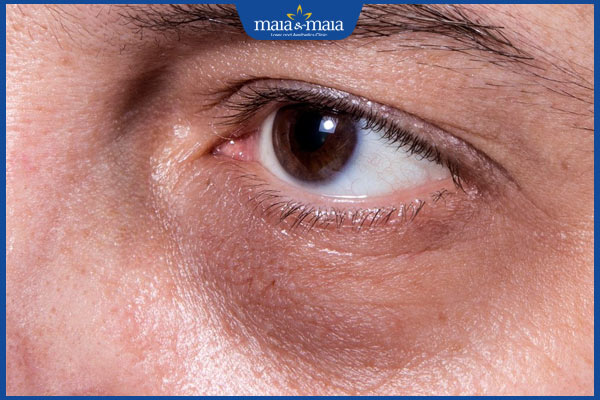 hốc mắt lõm sâu