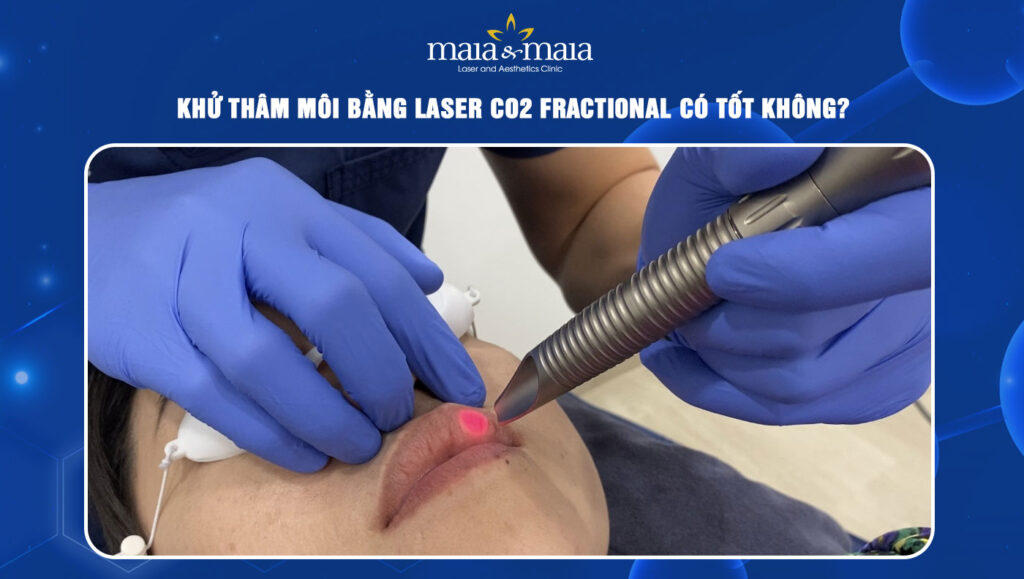 khử thâm môi bằng laser CO2 Fractional
