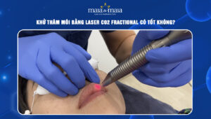 khử thâm môi bằng laser CO2 Fractional