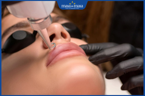Khử thâm môi bằng laser có hiệu quả không? Ai nên thực hiện? 4 laser làm hồng môi