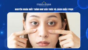 mắt thâm như gấu trúc