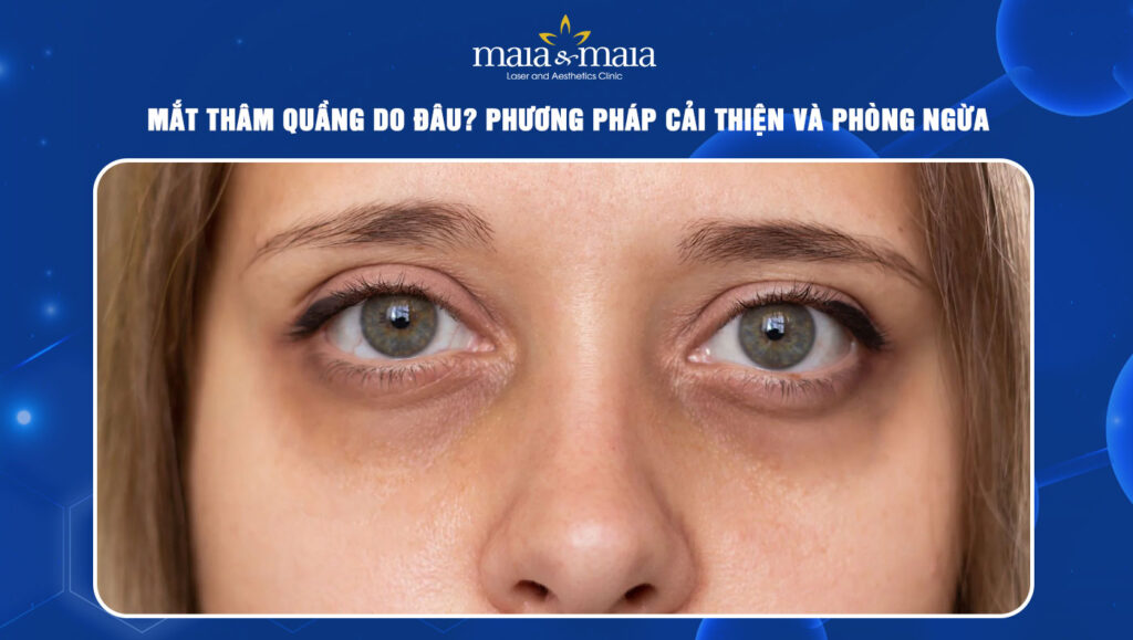 Mắt thâm quầng do đâu? Cách cải thiện và phòng ngừa 1 mắt thâm quầng