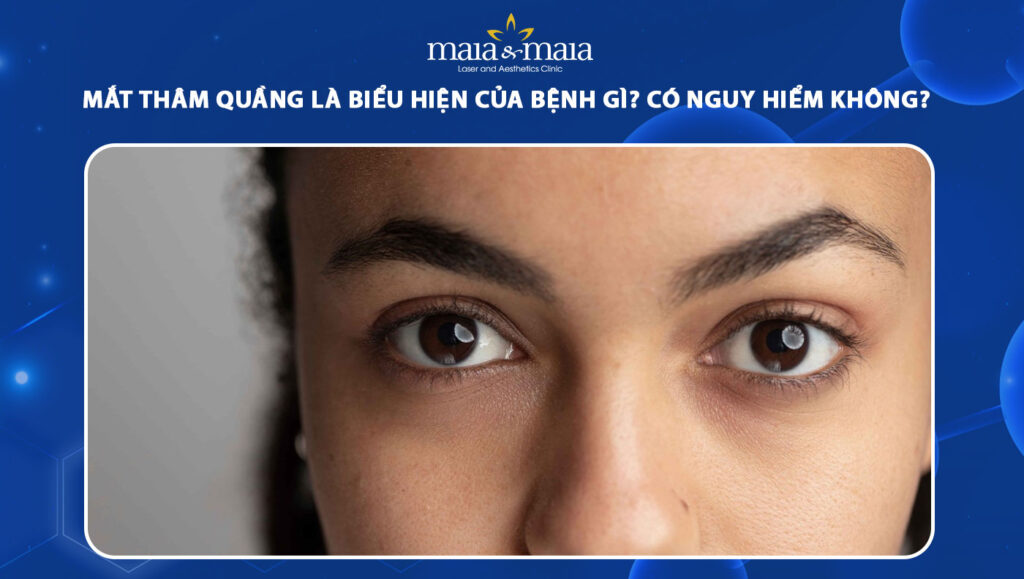 mắt thâm quầng là biểu hiện của bệnh gì