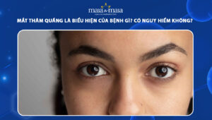 mắt thâm quầng là biểu hiện của bệnh gì