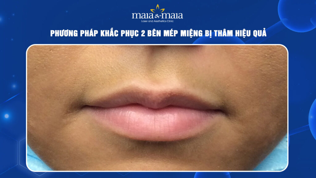 Mép miệng bị thâm