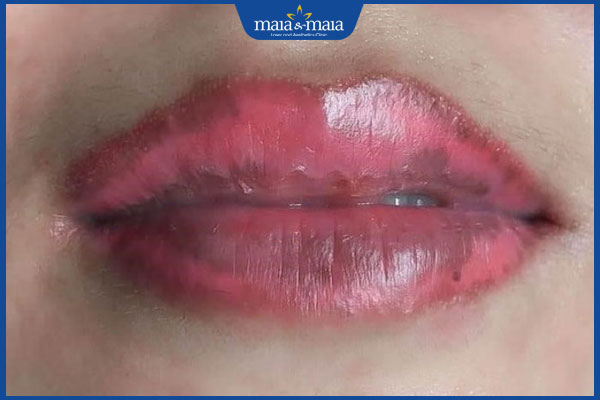 môi bị sưng sau khử thâm