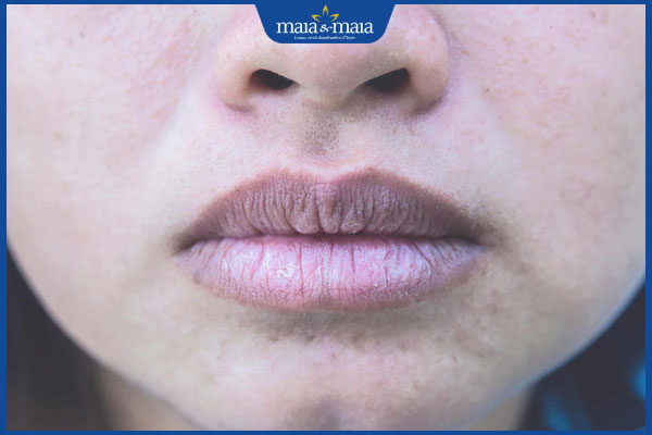 môi bị thâm tím