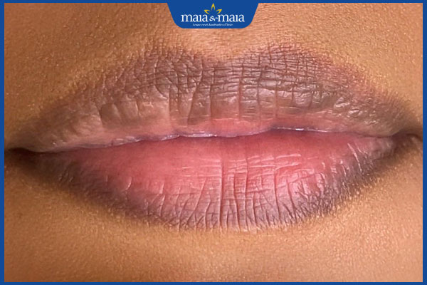 môi bị thâm viền