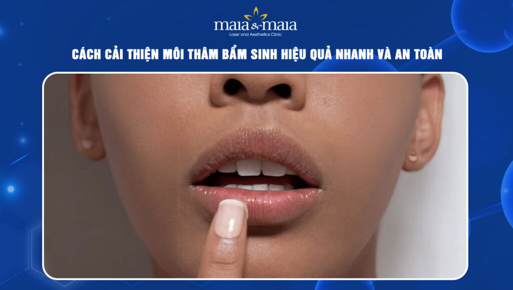 Môi thâm bẩm sinh