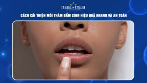 Môi thâm bẩm sinh