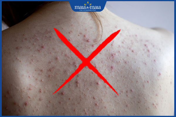 người có nhiều mụn