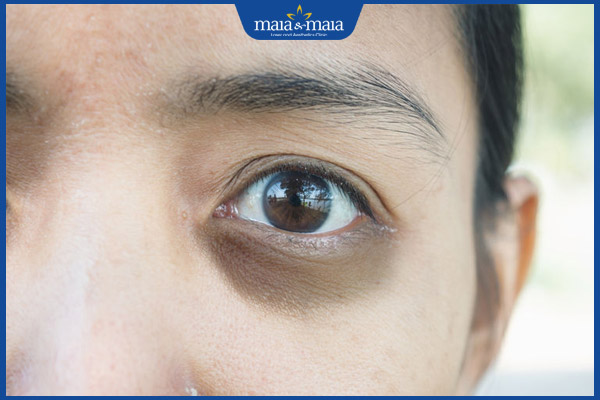 quầng mắt thâm đen