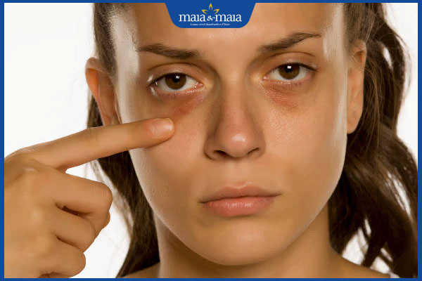 Tiêm meso trị thâm mắt có tốt không? Hiệu quả và lưu ý 4 quầng thâm mắt